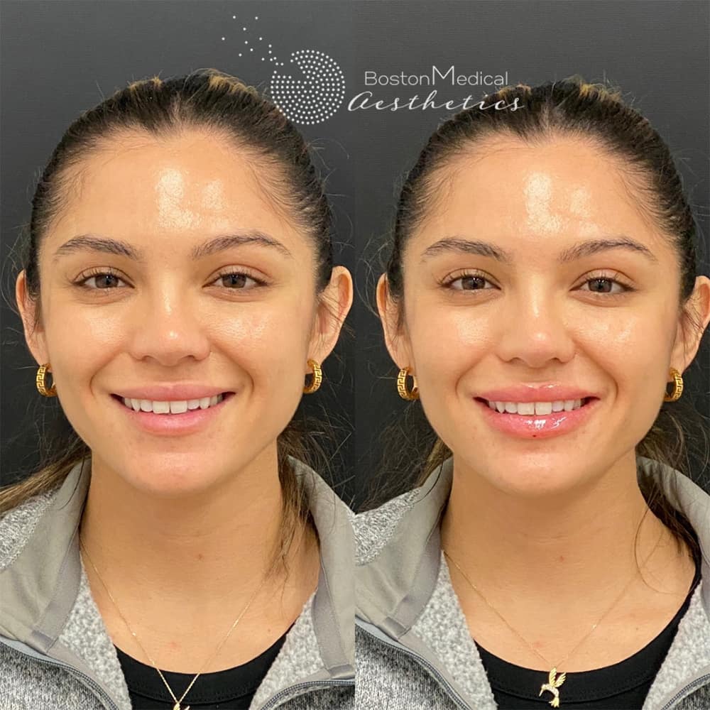 Lip fillers Before & After Image