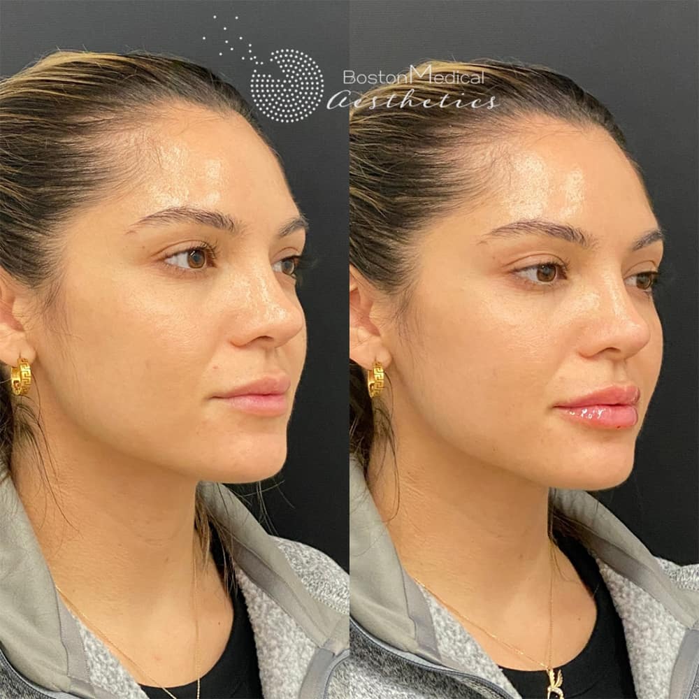 Lip fillers Before & After Image