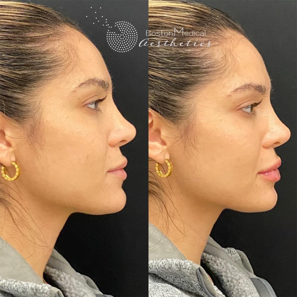 Lip fillers Before & After Image