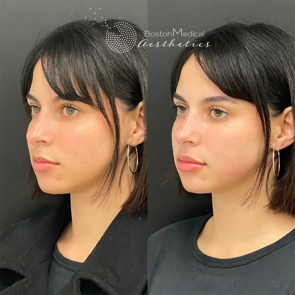 Lip fillers Before & After Image