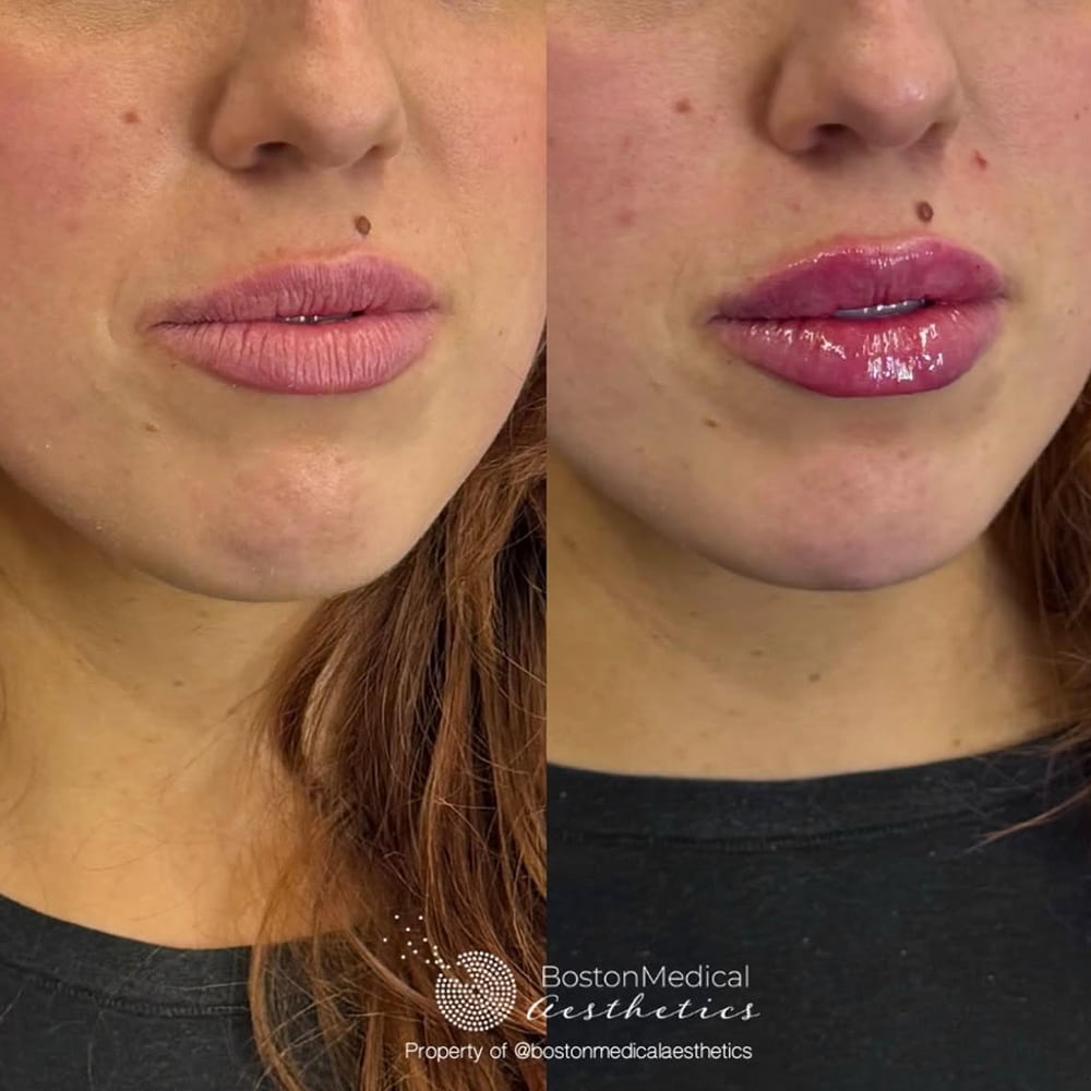 Lip fillers Before & After Image