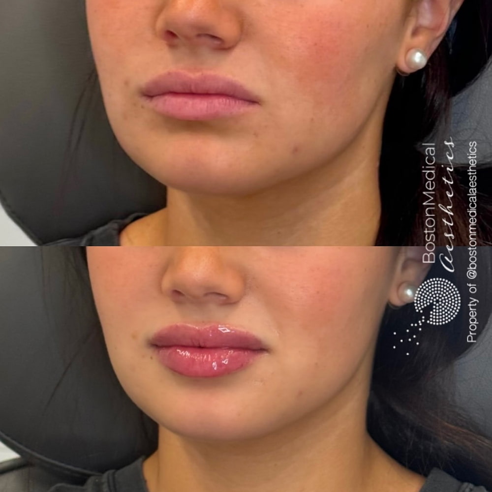 Lip fillers Before & After Image