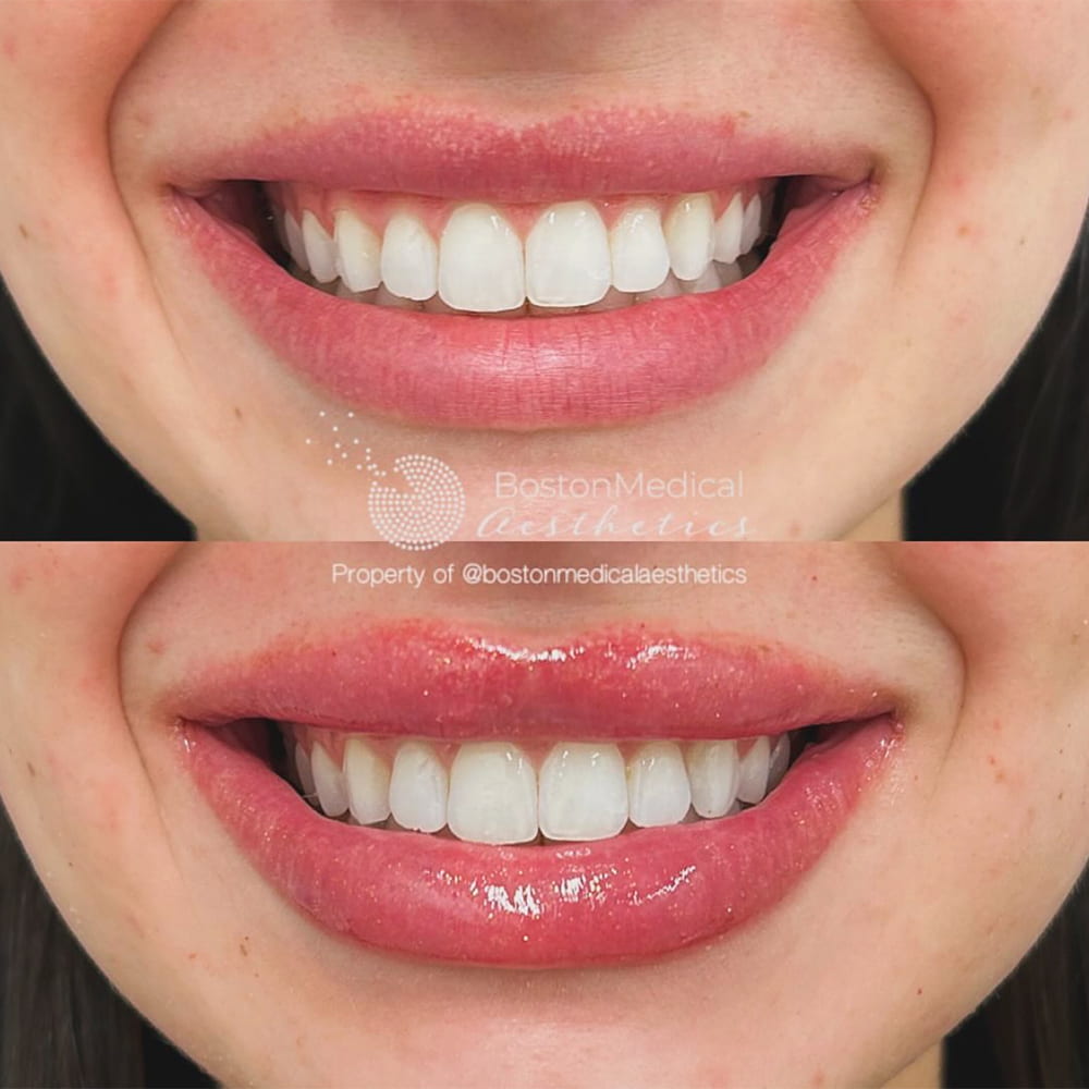 Lip fillers Before & After Image