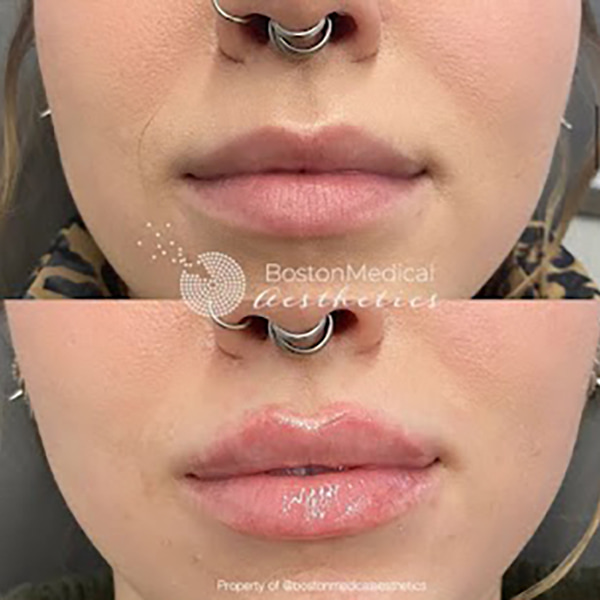 Lip fillers Before & After Image