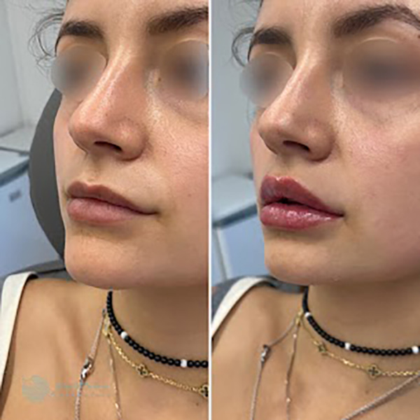 Lip fillers Before & After Image