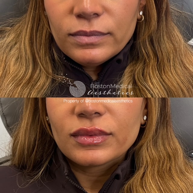 Lip Fillers Before & After Photo