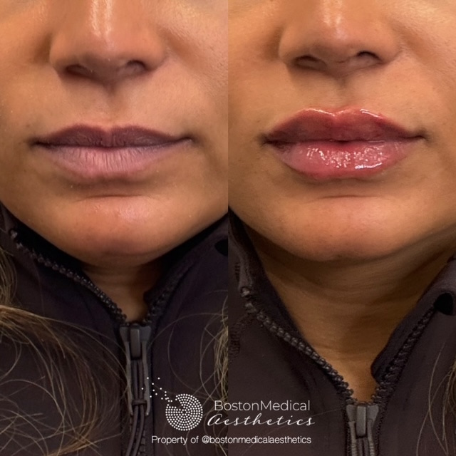 Lip Fillers Before & After Image