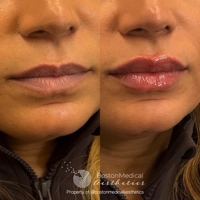 Lip Fillers Before & After Photo