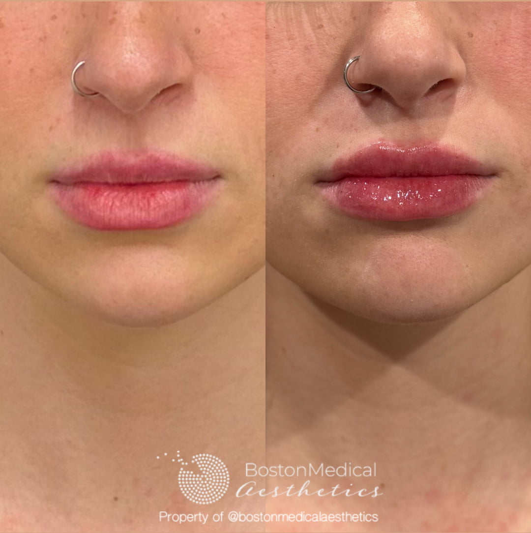 Lip Fillers Before & After Photo