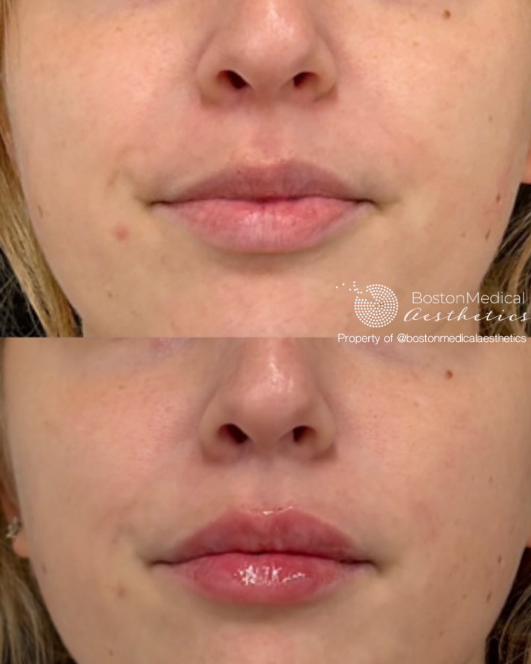Lip Fillers Before & After Photo