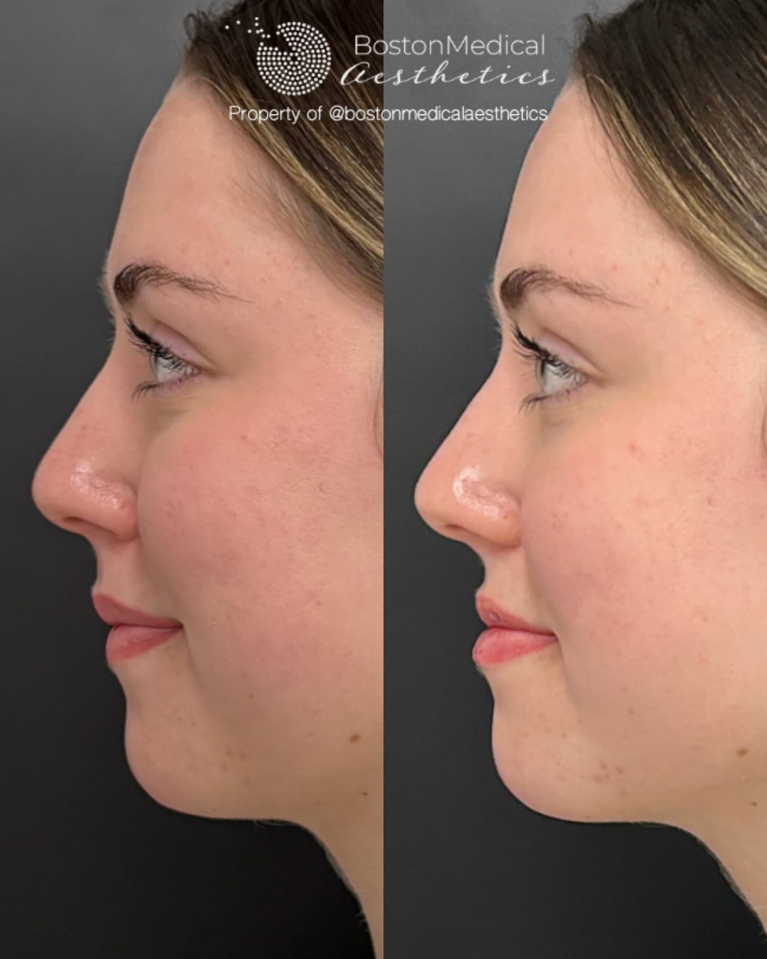 Lip Fillers Before & After Image