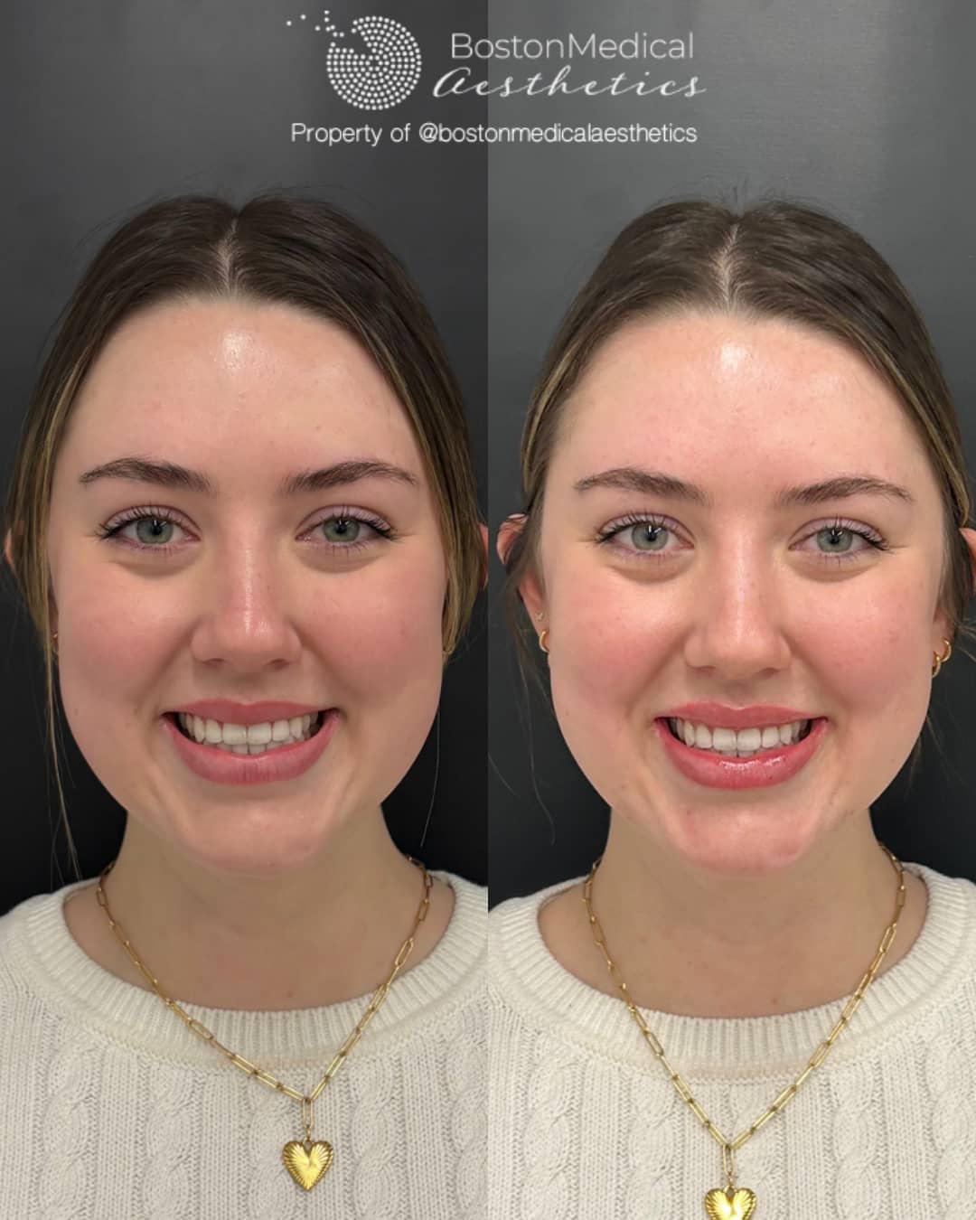 Lip Fillers Before & After Image