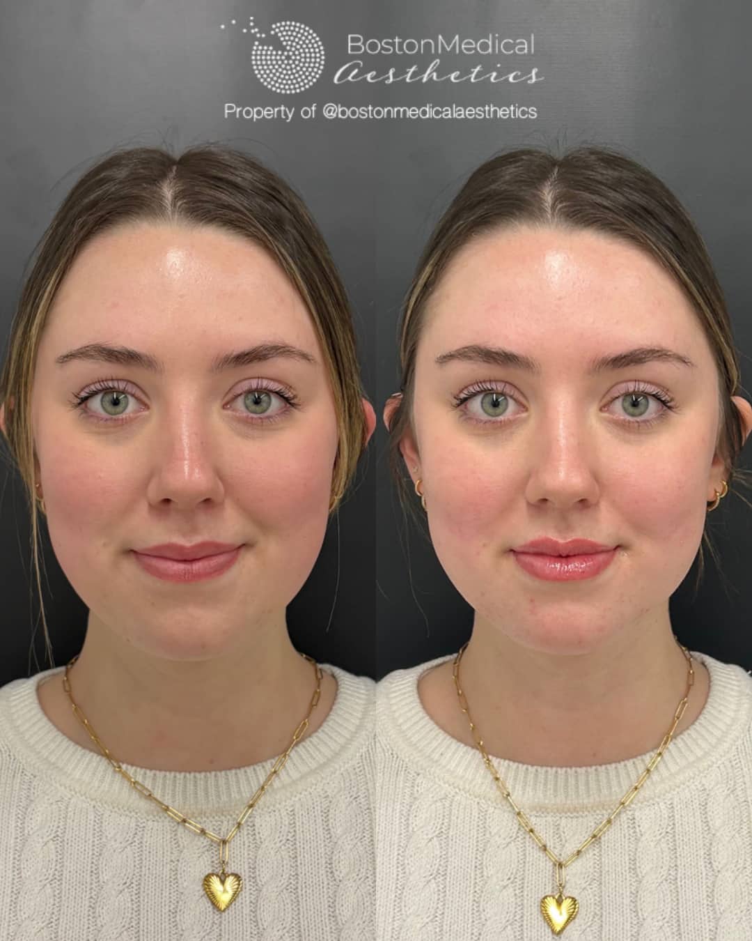 Lip Fillers Before & After Image