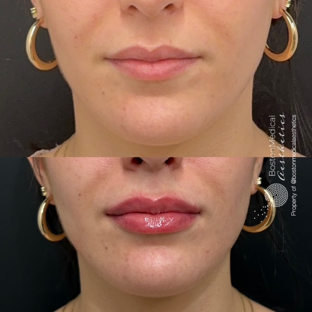 Lip Fillers Before & After Photo