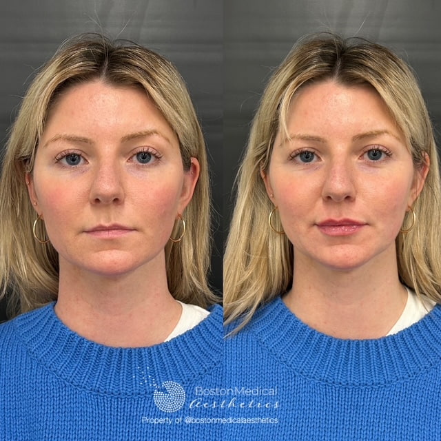 Lip Fillers Before & After Photo