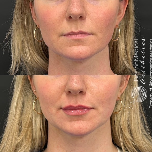 Lip Fillers Before & After Image