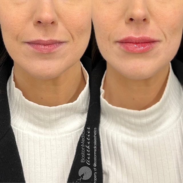 Lip Fillers Before & After Image