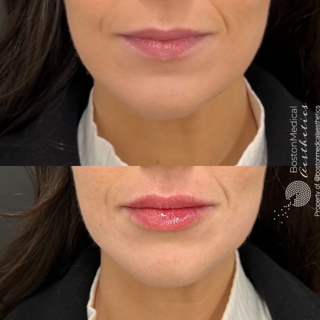 Lip Fillers Before & After Photo