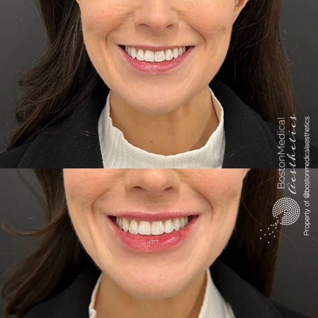 Lip Fillers Before & After Image