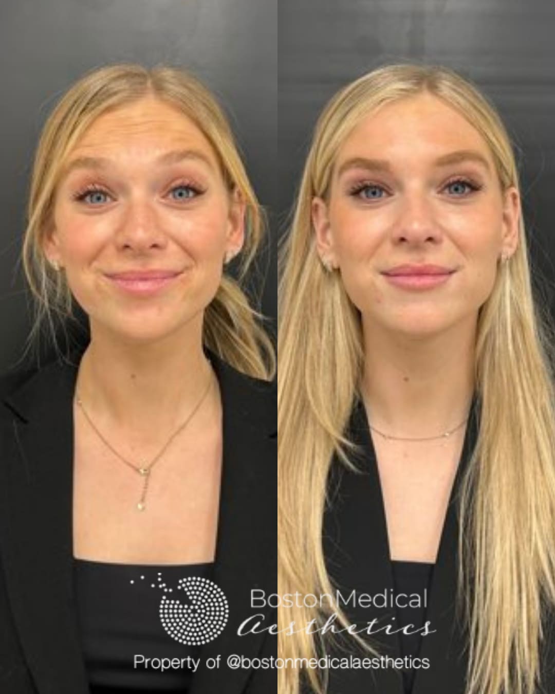 Lip Fillers Before & After Image