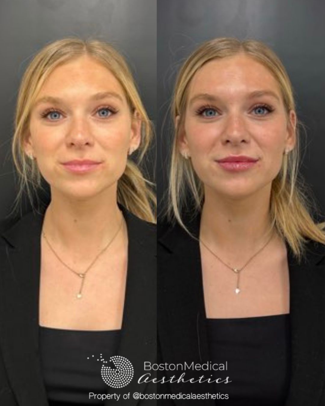Lip Fillers Before & After Photo