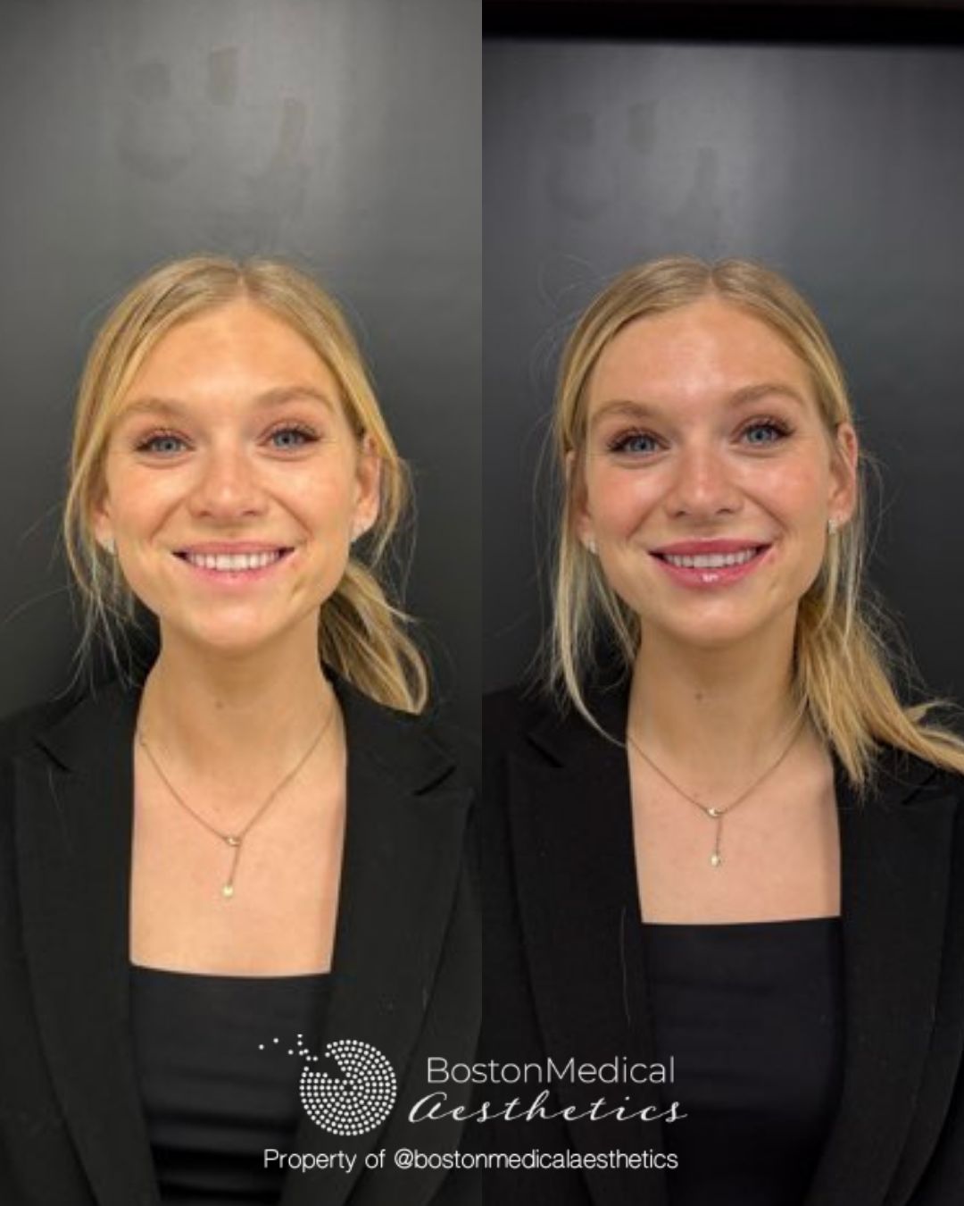 Lip Fillers Before & After Image