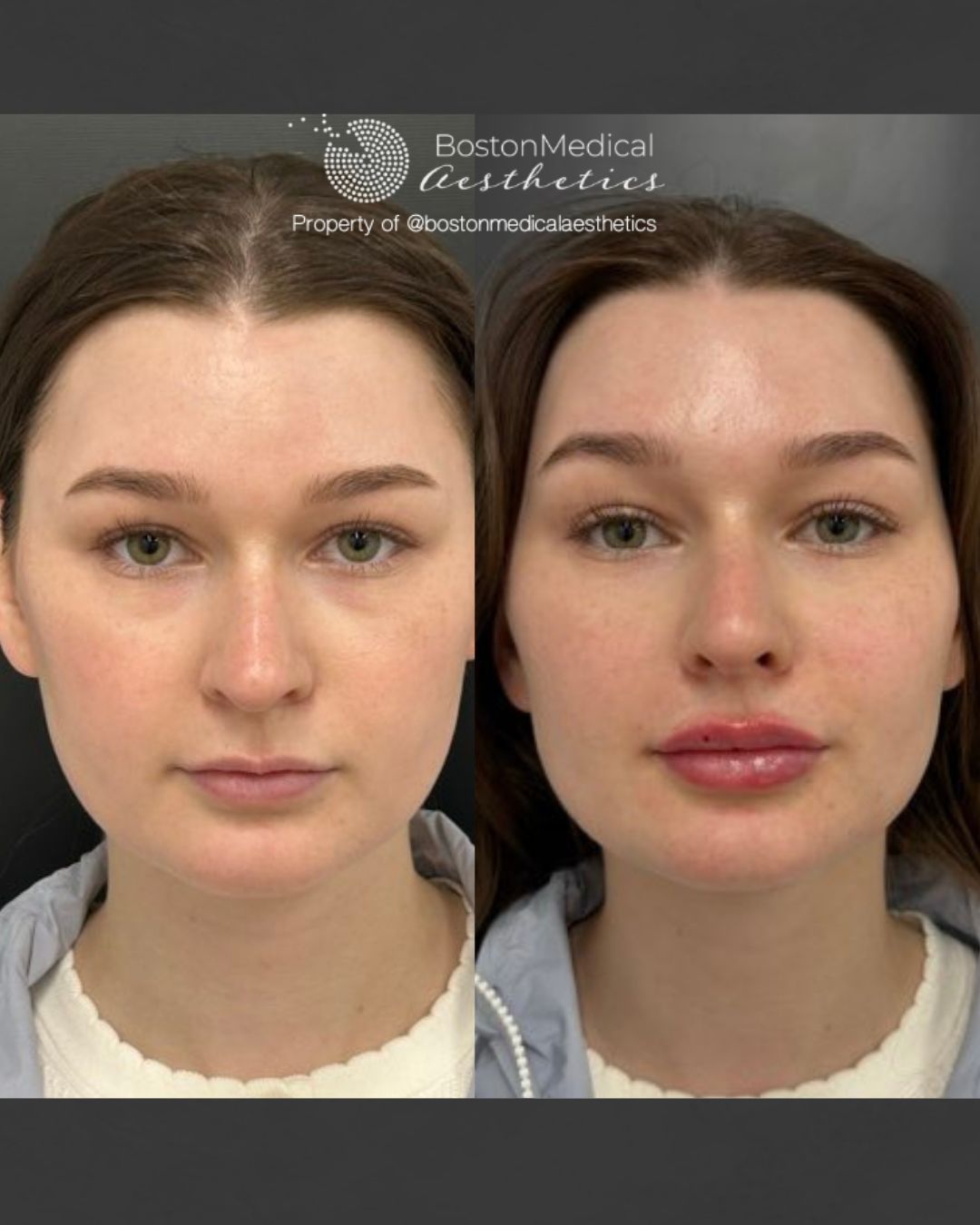 Lip Fillers Before & After Image