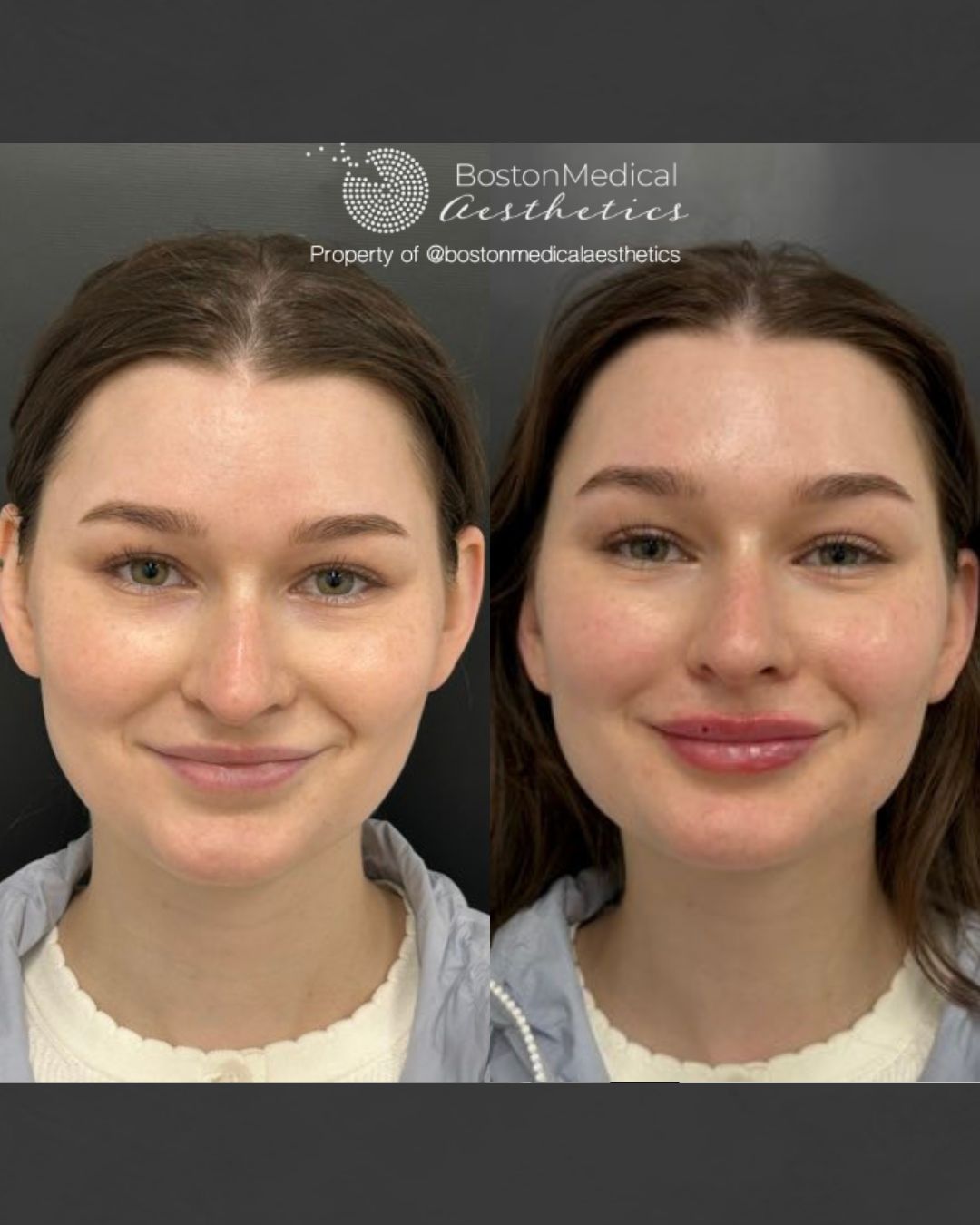 Lip Fillers Before & After Image