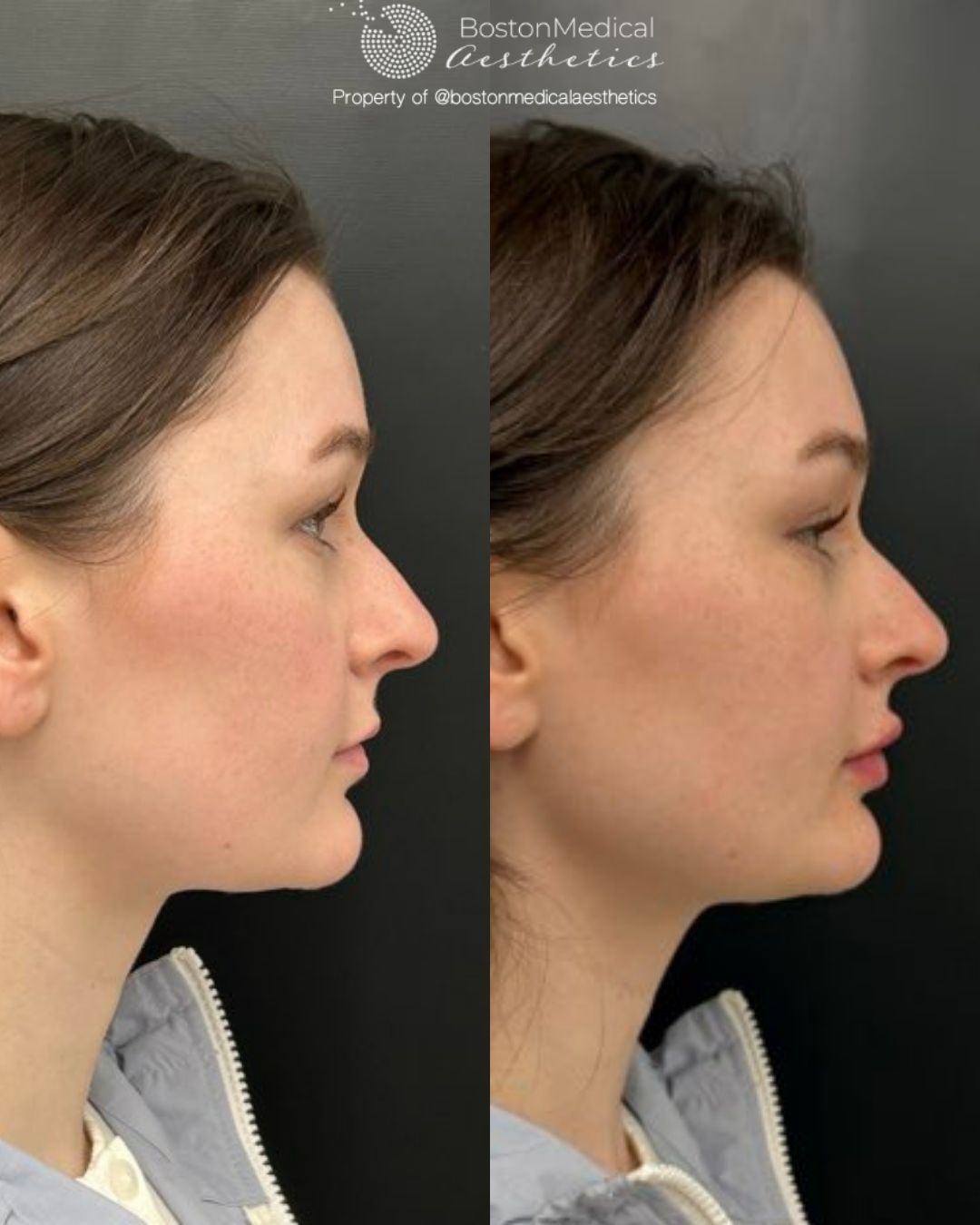 Lip Fillers Before & After Image