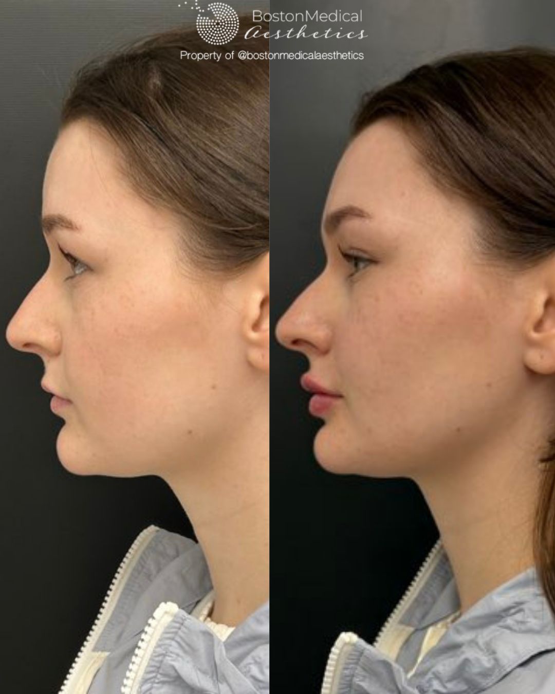 Lip Fillers Before & After Image