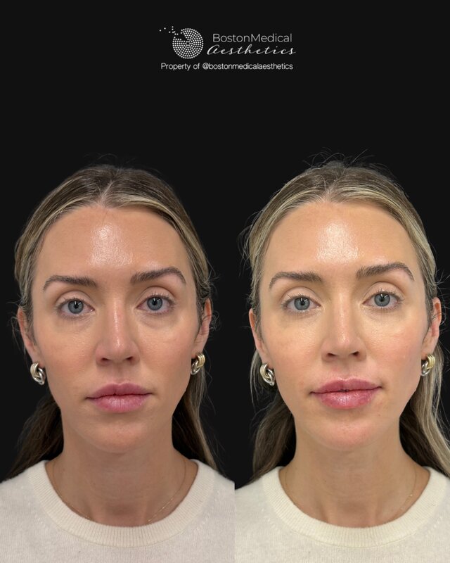 Lip Fillers Before & After Photo