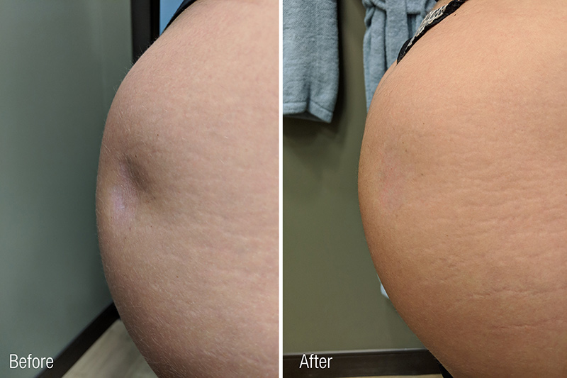 Liquid Butt Lift in Boston, MA