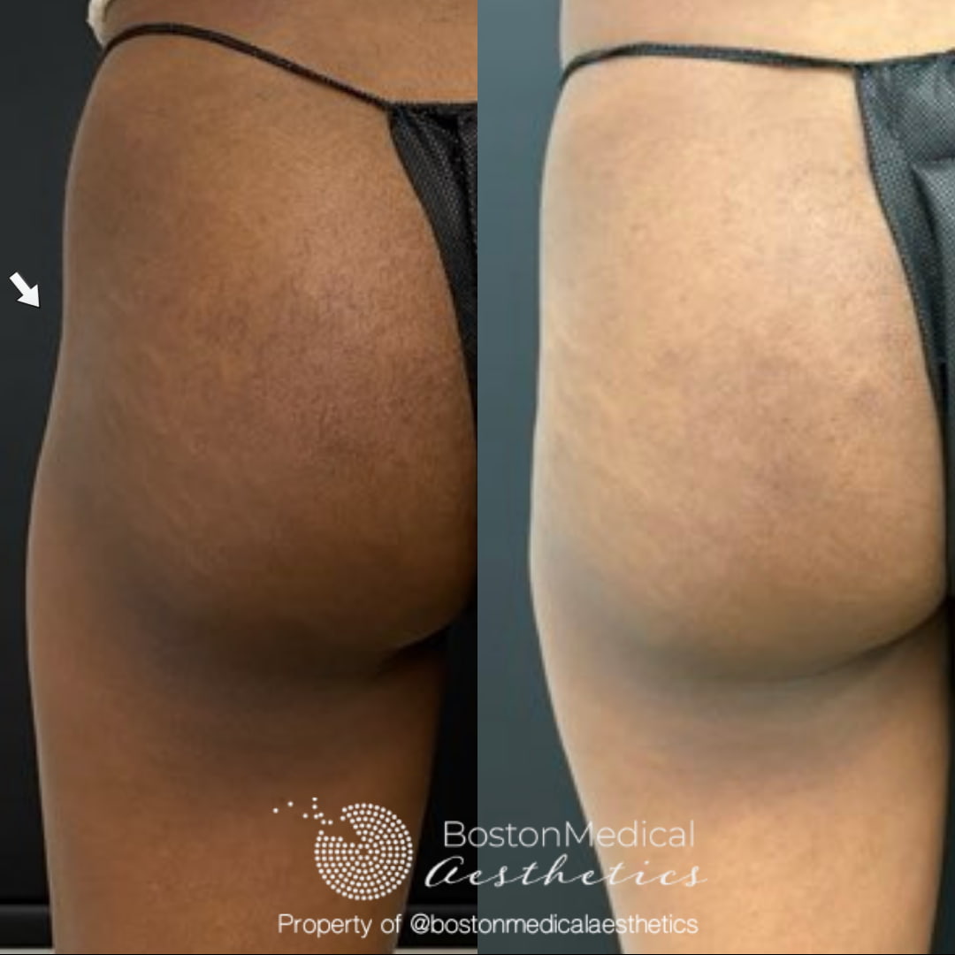 Liquid Butt Lift Before & After Photo