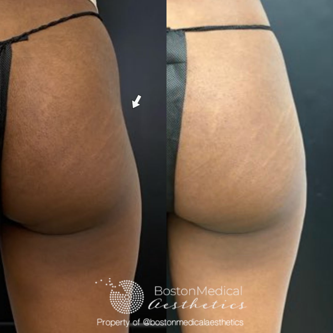 Liquid Butt Lift Before & After Photo