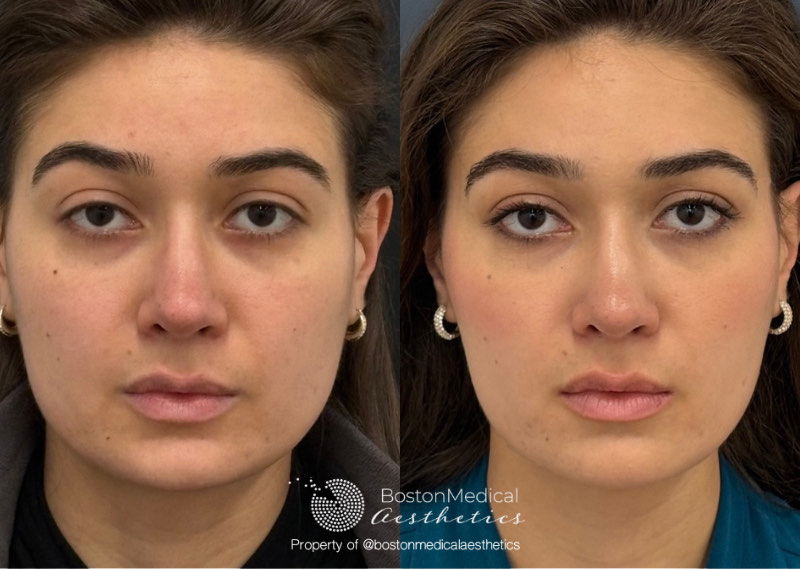 Masseter Before & After Photo
