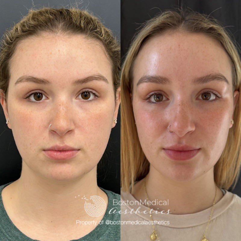 Masseter Before & After Photo