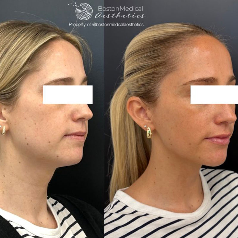Masseter Before & After Photo