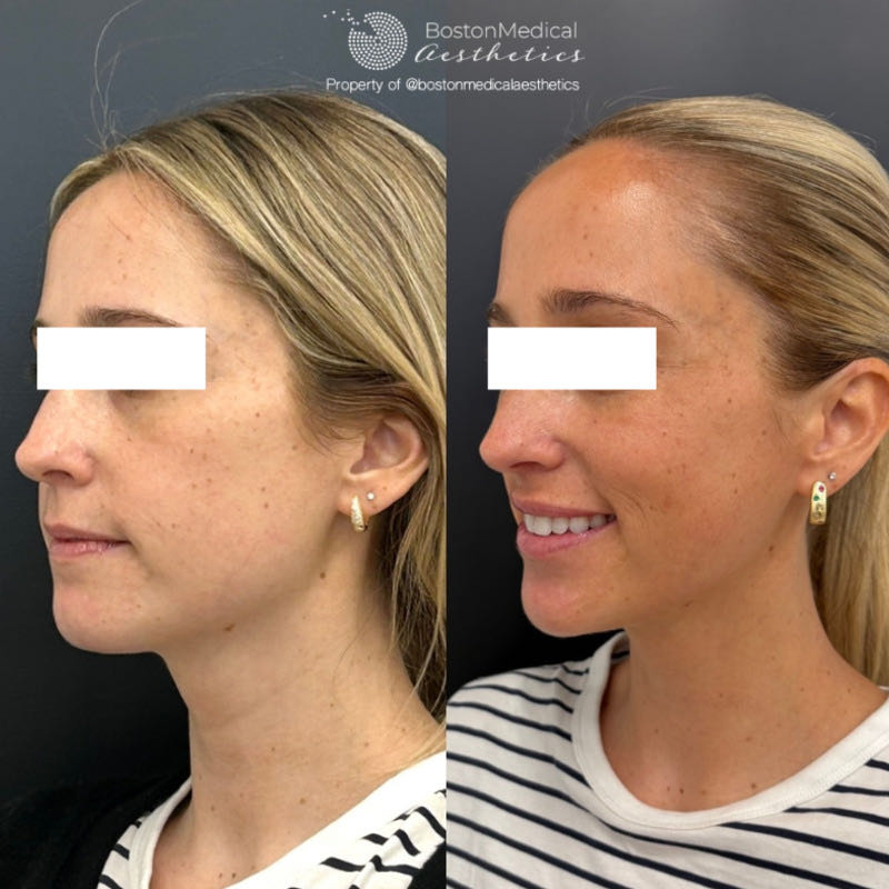 Masseter Before & After Photo