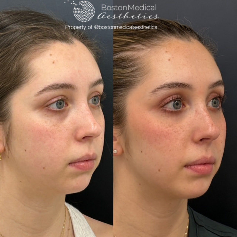 Masseter Before & After Photo