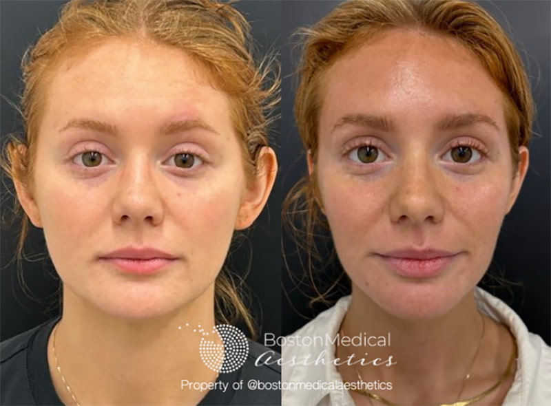 Masseter Before & After Photo