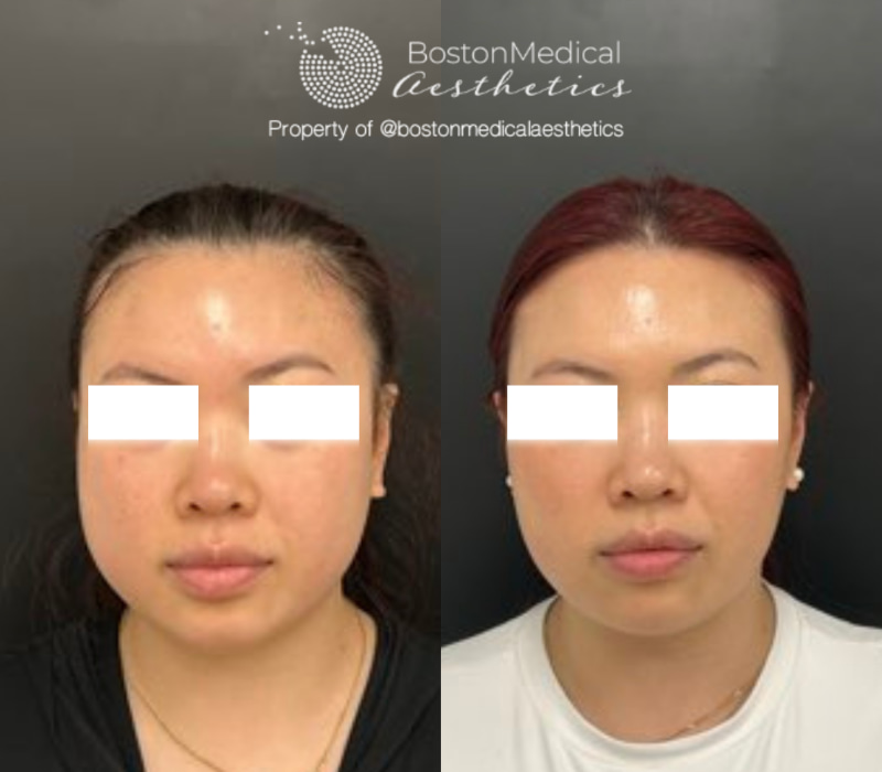 Masseter Before & After Photo