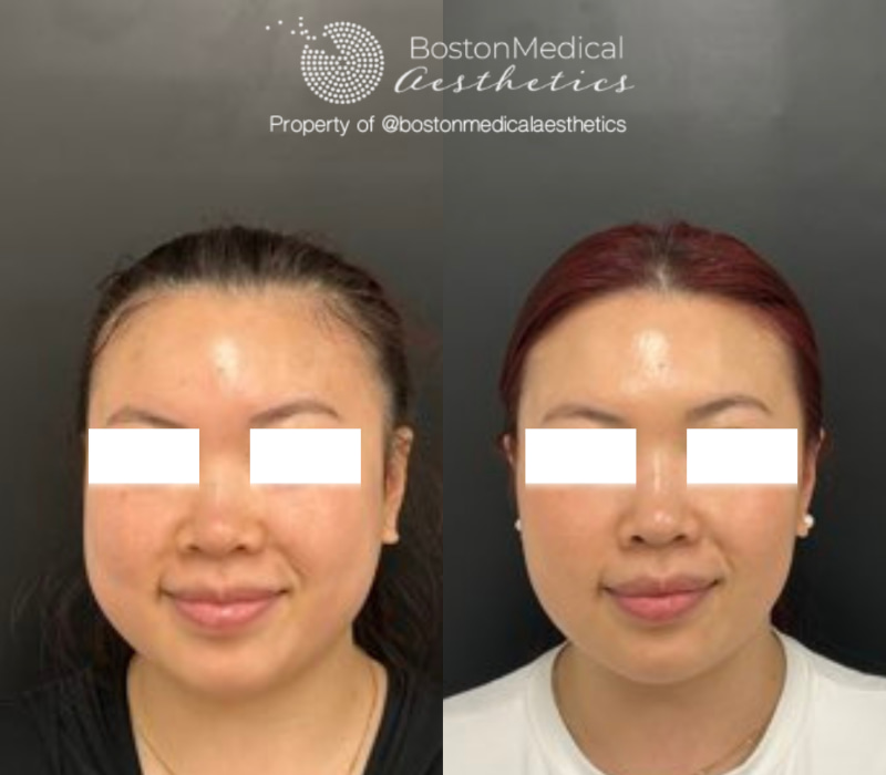 Masseter Before & After Photo