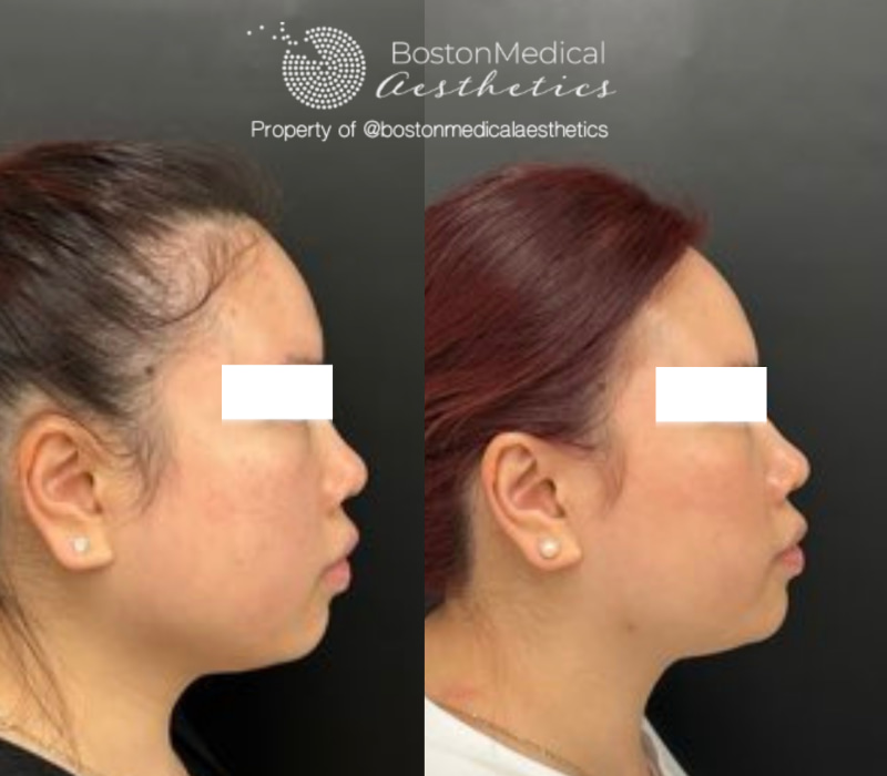 Masseter Before & After Photo
