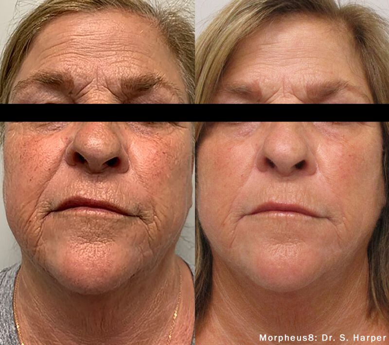 Morpheus8 Microneedling Before & After Photo