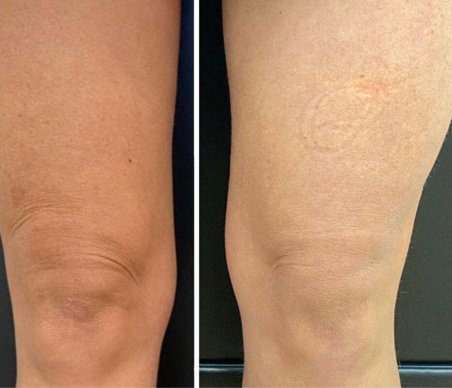 Microneedling Before & After Photo