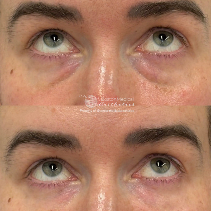 Pure PDGF+ Before & After Photo
