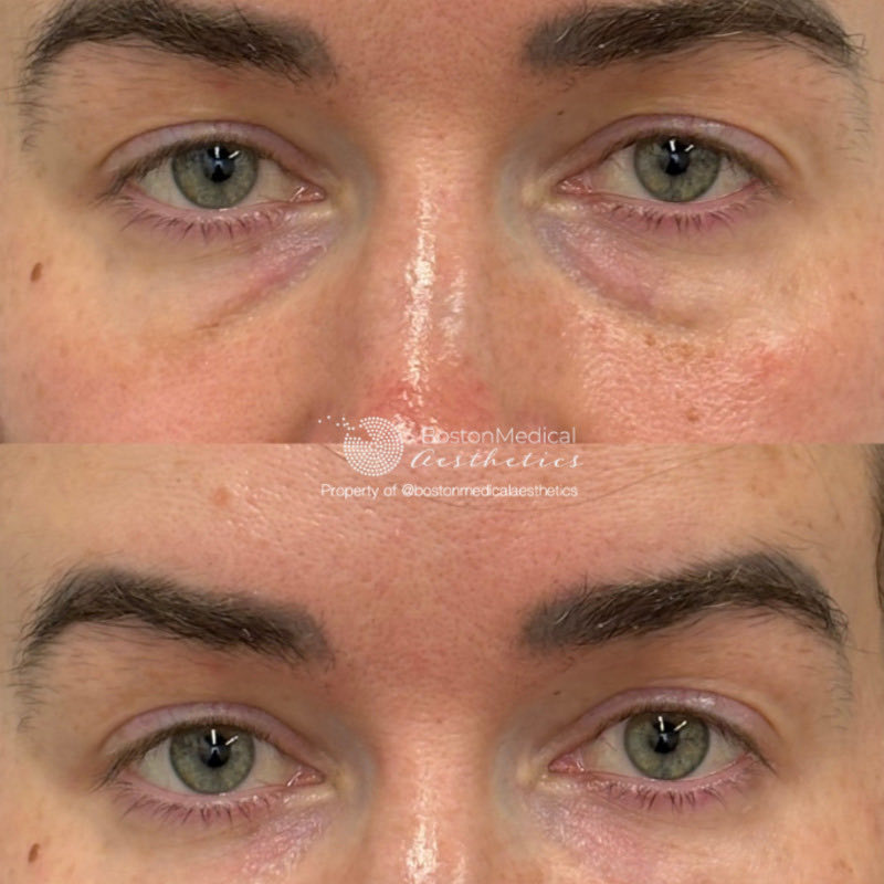 Pure PDGF+ Before & After Photo