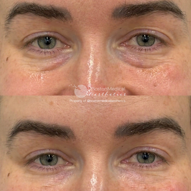 Pure PDGF+ Before & After Photo