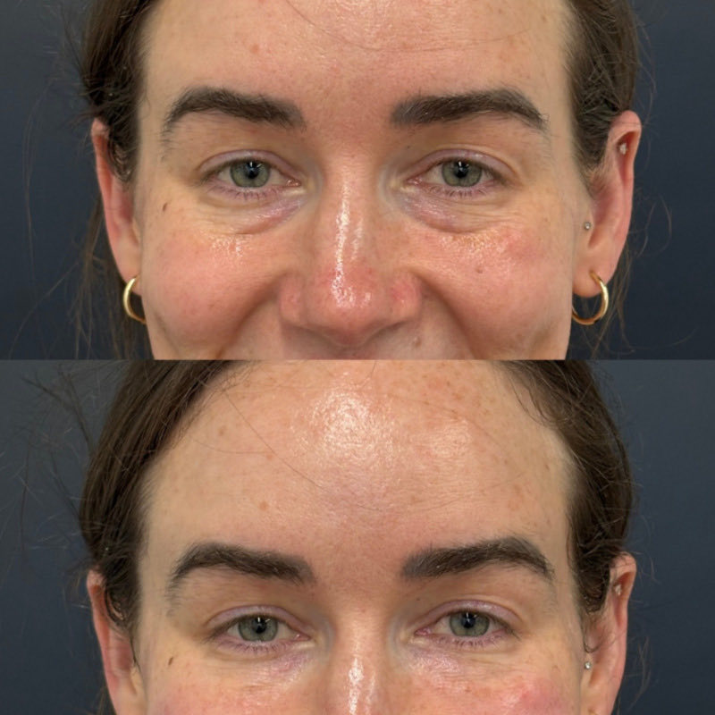 Pure PDGF+ Before & After Photo