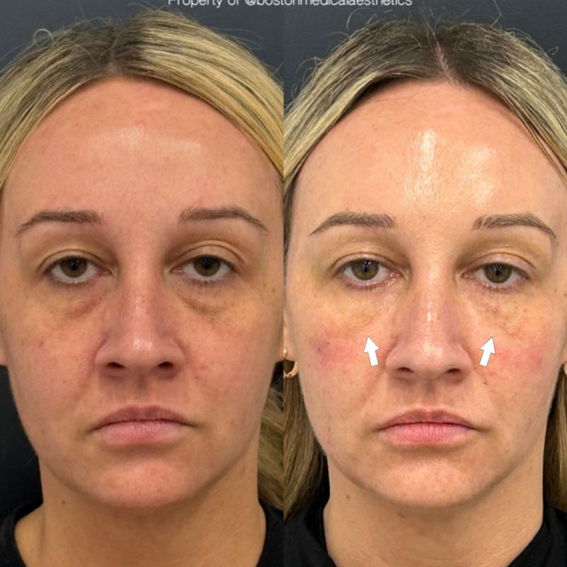 Pure PDGF+ Before & After Photo